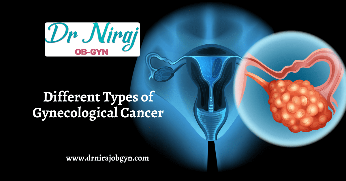 Different Types of Gynecological Cancer